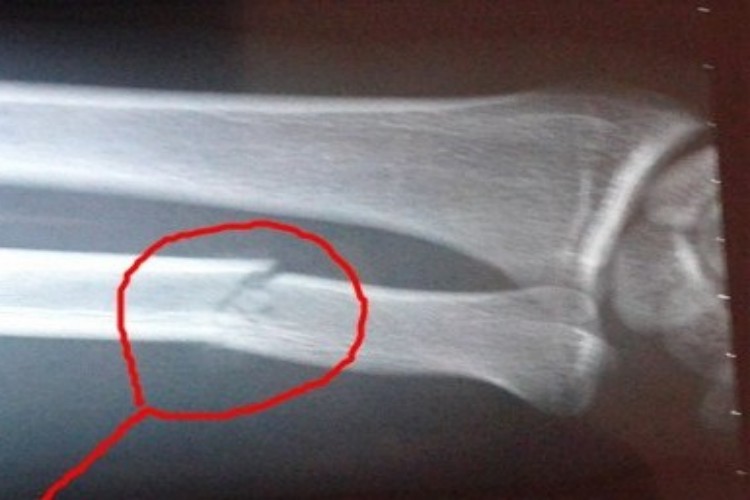 左手尺骨骨折X线图 左手尺骨骨折X线图