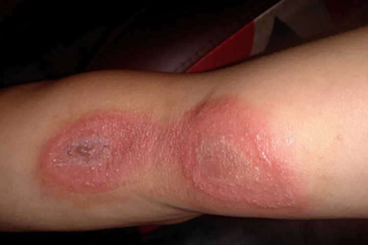 症状小螺菌型鼠咬热可累及胳膊,出现小水疱的症状,伴有红斑,该病感染