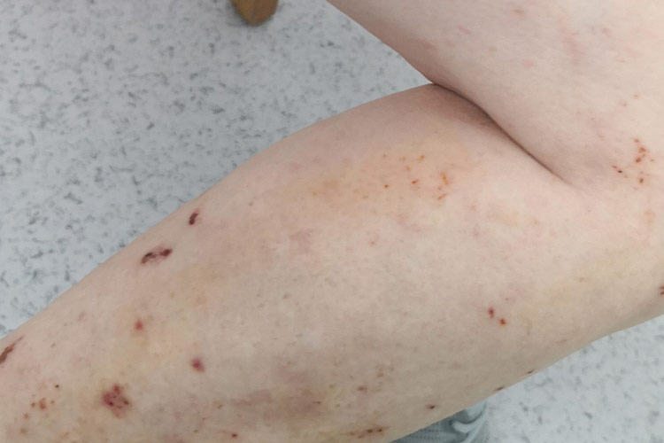 夏季皮炎搔抓后血痂图