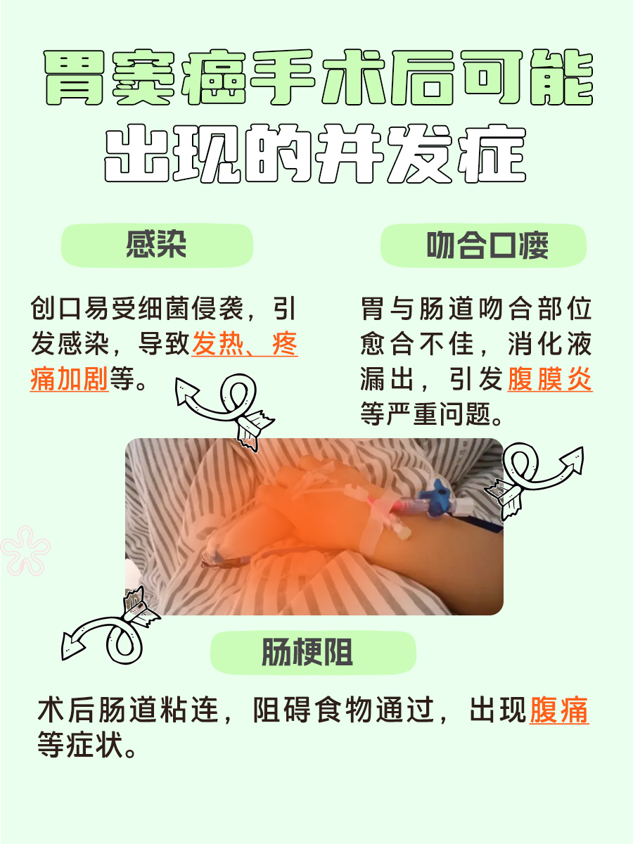 别糊涂！胃窦癌手术是否大手术判断