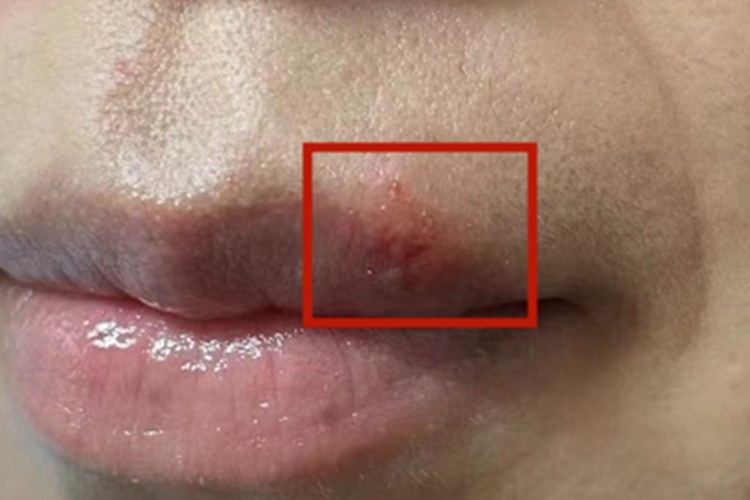 单纯疱疹嘴唇上面起小水疱图