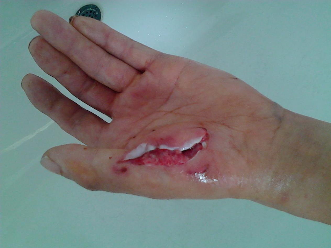 狗咬的伤口重症图