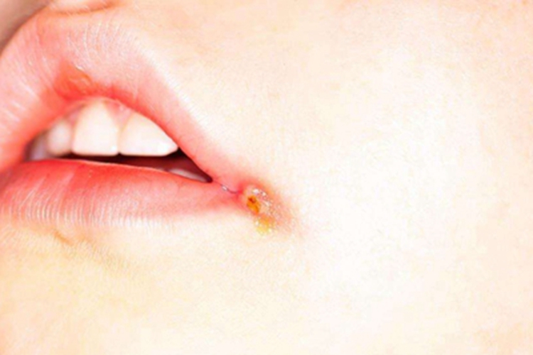 口角炎糜烂渗出图 口角炎糜烂渗出图