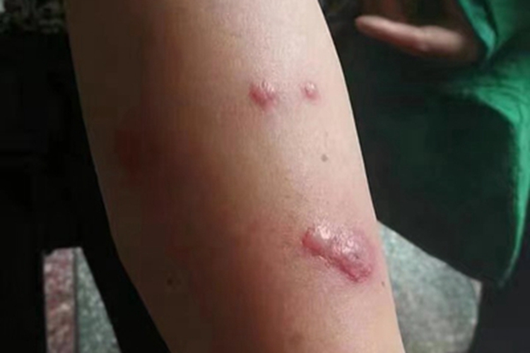 急性发热性嗜中性皮病胳膊结节图