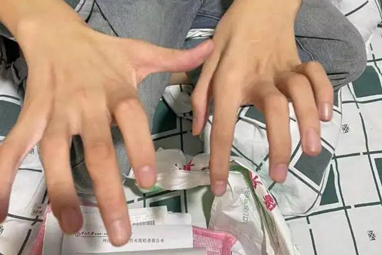 平山病斜坡症肌肉萎缩图 平山病斜坡症肌肉萎缩图