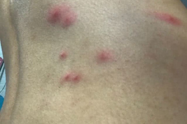 蠓叮咬腰部丘疹图