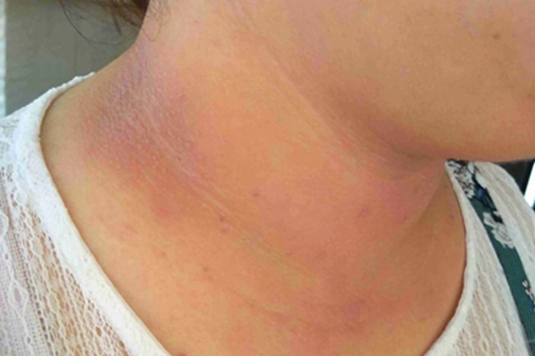 类癌综合征颈部红斑图 类癌综合征颈部红斑图