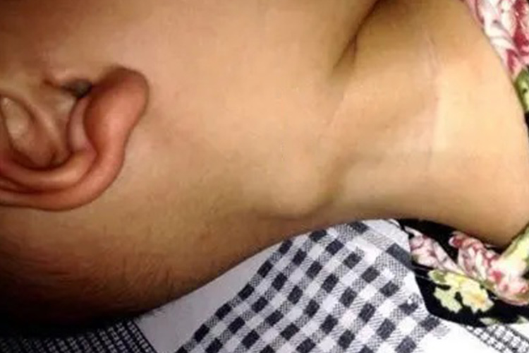 男性艾滋病淋巴结肿大图 男性艾滋病淋巴结肿大图