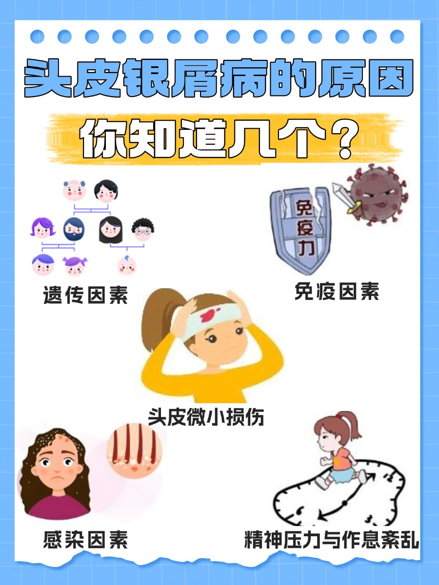 头皮银屑病的原因，你知道几个？