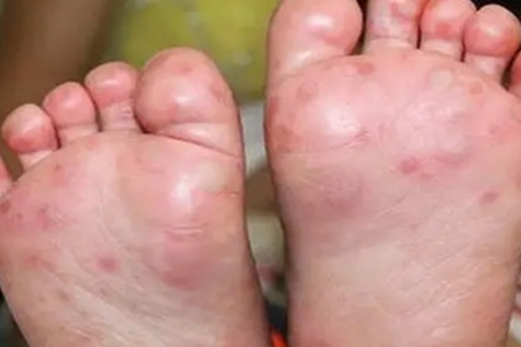 手足口病脚底红斑图