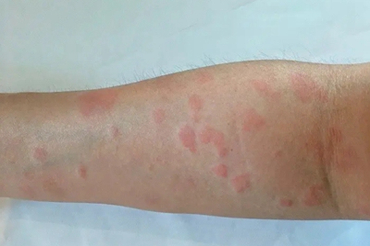 色素性痒疹胳膊出现风团图 色素性痒疹胳膊出现风团图