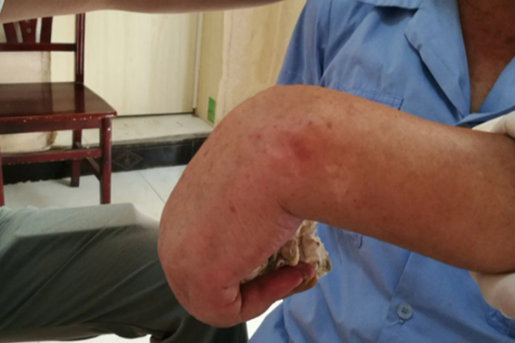 脑梗致手腕肌肉挛缩后遗症图 脑梗致手腕肌肉挛缩后遗症图