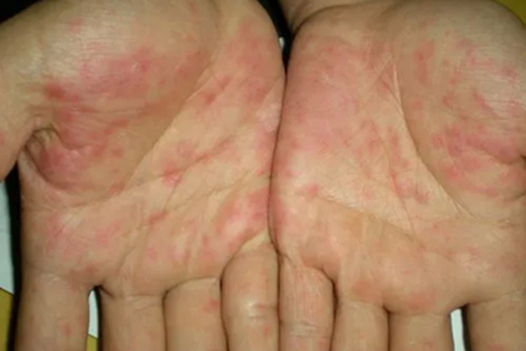 轻型麻疹手掌心有红点图