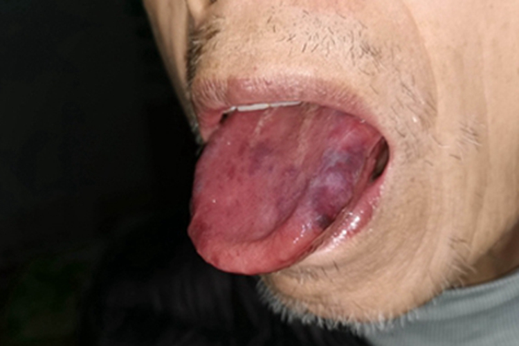 舌炎舌头紫斑图