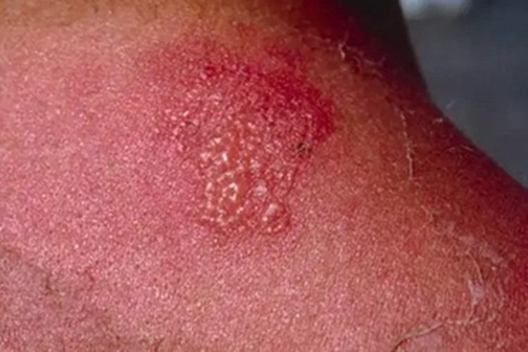 日光性皮炎肩部脱皮图