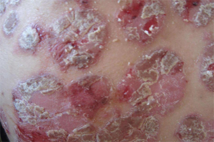 牛皮癣皮肤白色癣图