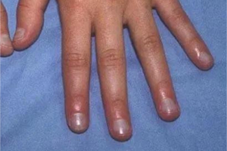 手足发绀症肿图 手足发绀症肿图