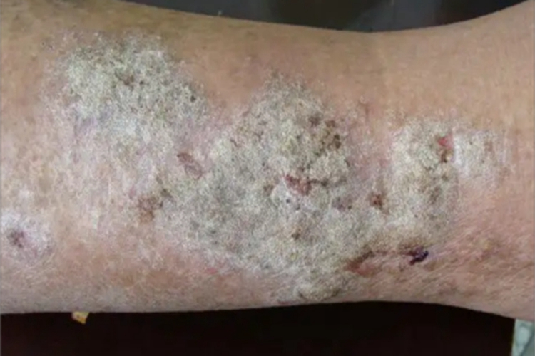 砷角化病小腿症状图