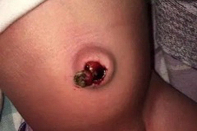 脐窝湿疹肚脐破溃结痂图 脐窝湿疹肚脐破溃结痂图