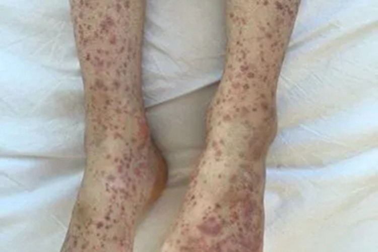 异常蛋白血症紫癜脚踝紫斑图