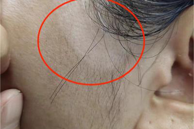 节段型白癜风耳前症状图