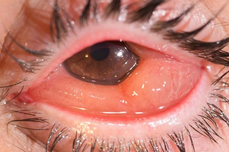 急性或亚急性细菌性结膜炎疙瘩图 急性或亚急性细菌性结膜炎疙瘩图