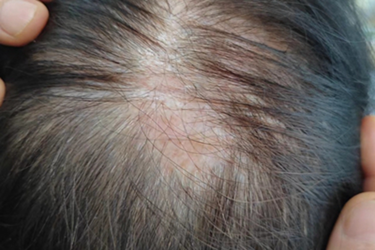 脂溢性皮炎头皮脱发图