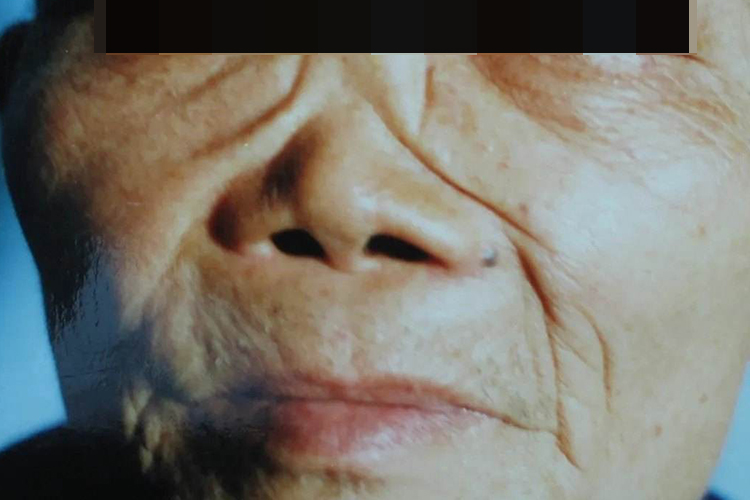 梅毒塌鼻梁图 梅毒塌鼻梁图