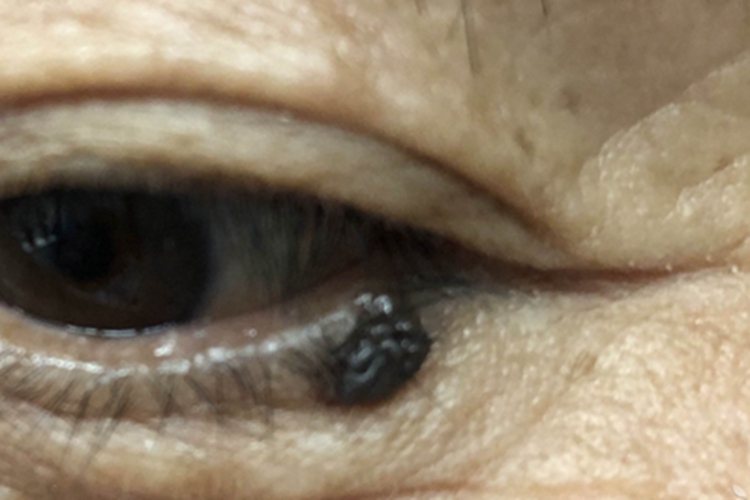 皮内痣眼睑症状图