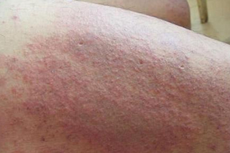 穿通性疾病大腿小红疙瘩图
