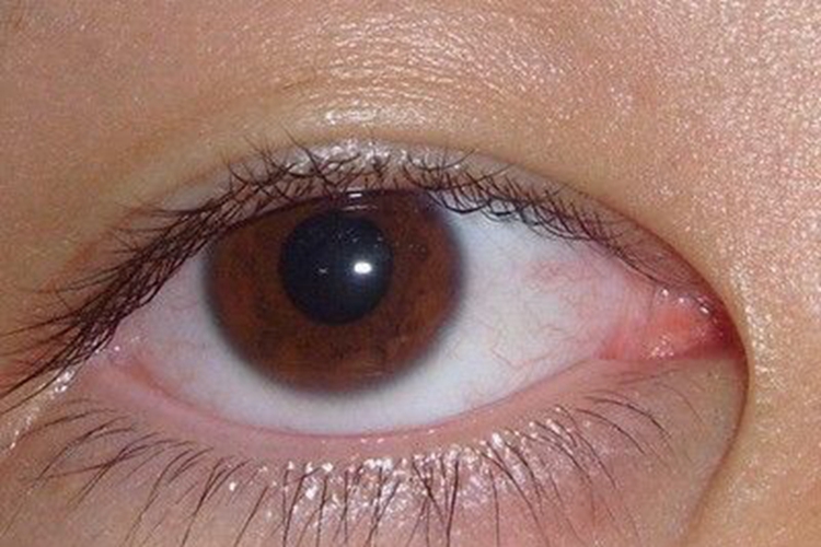 干眼症眼球有少量血丝图