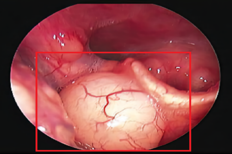 人参果过敏咽喉血管水肿图