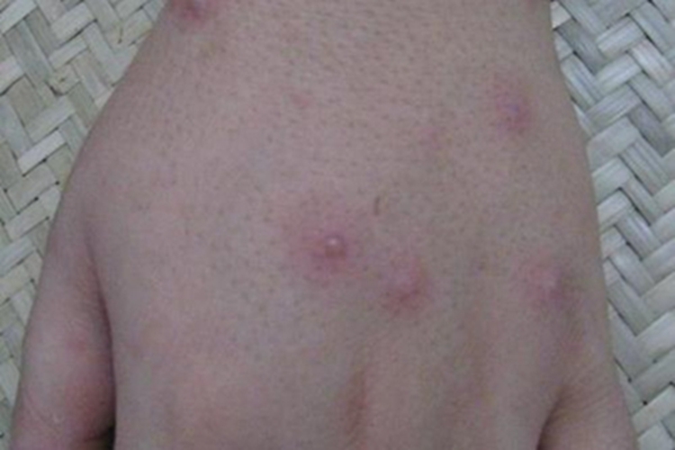 水痘手背上长很多小水疱图 水痘手背上长很多小水疱图