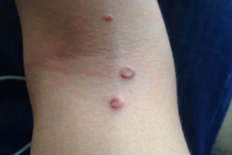 艾滋病初期手臂上寻常疣图