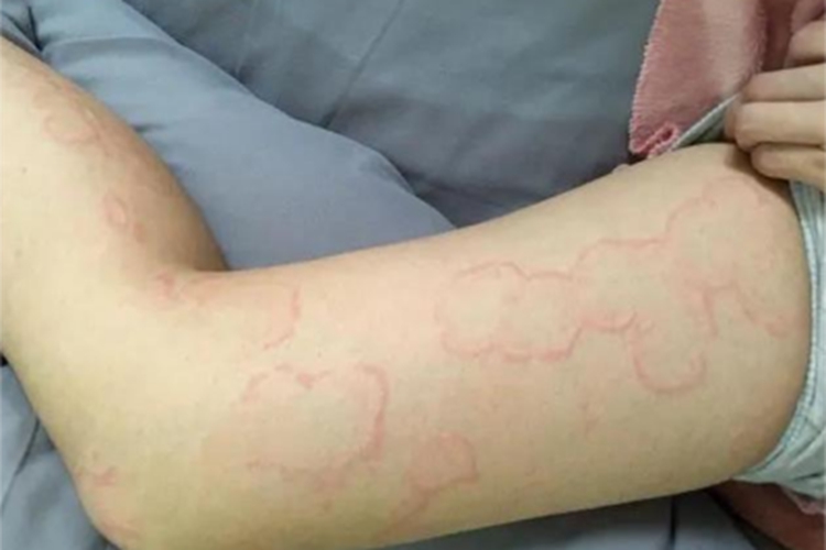 风湿热的皮肤表现腿红斑图