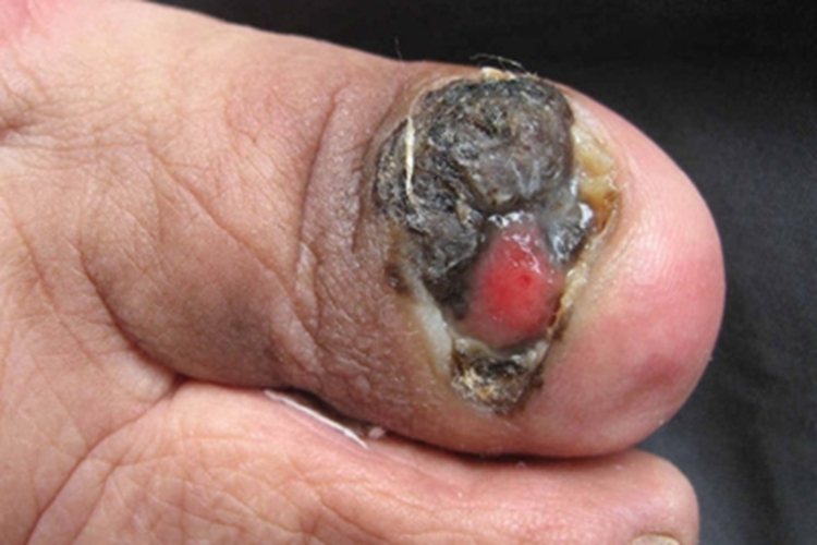 肢端雀斑样痣型黑色素瘤硬疙瘩图