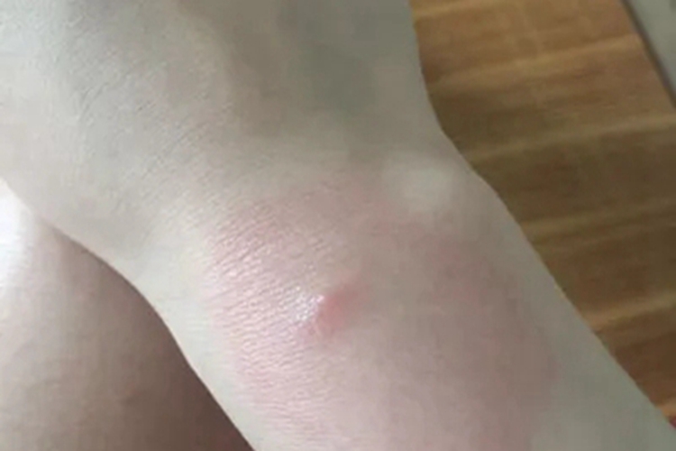 虫咬皮炎手腕红斑图 虫咬皮炎手腕红斑图