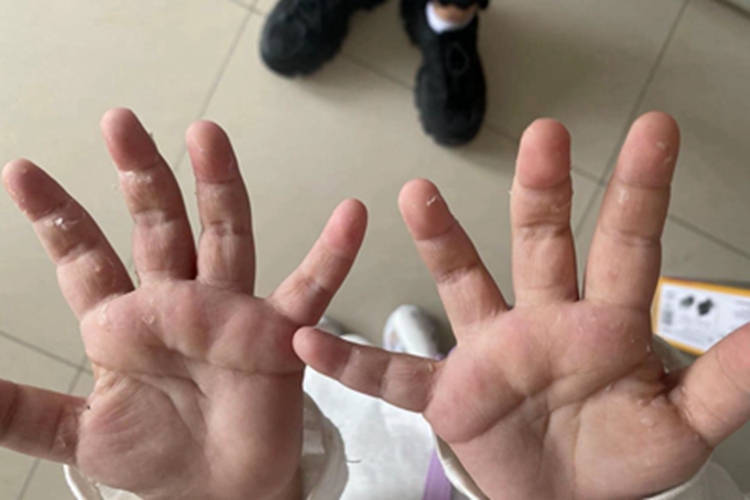 急性接触性皮炎脱皮图