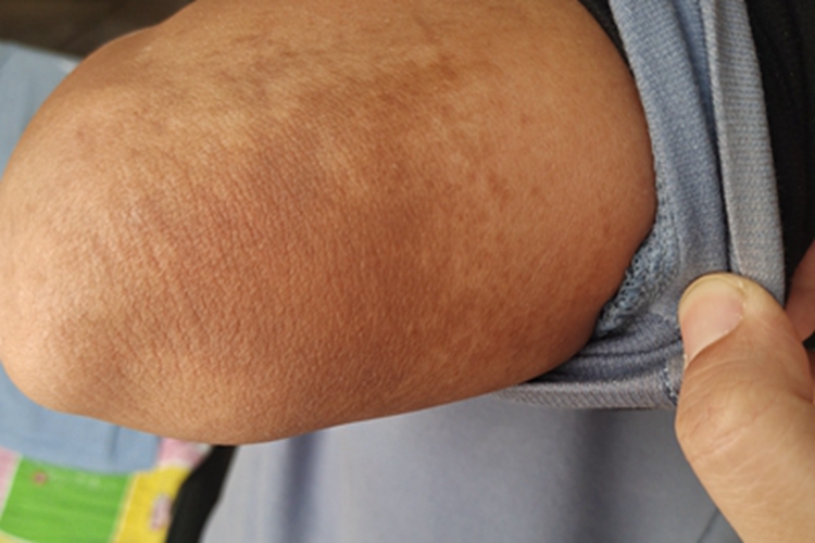 咖啡斑胳膊长斑图