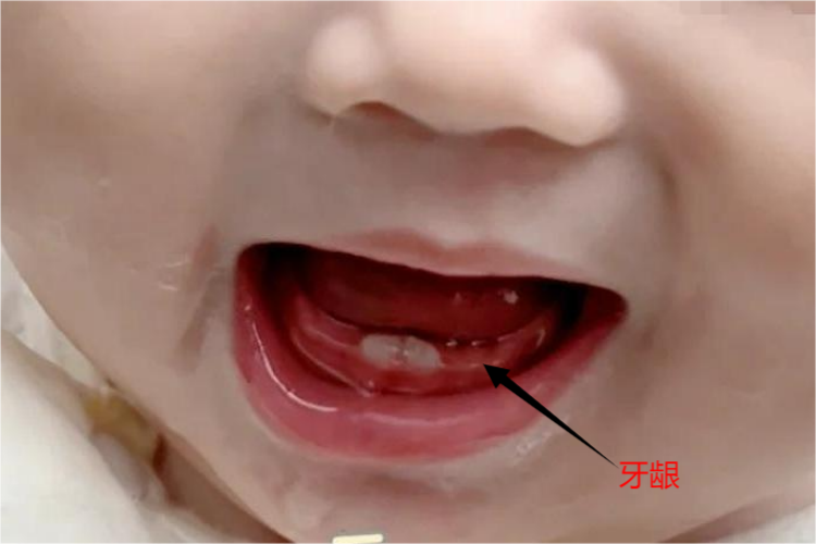 慢性龈炎牙龈红肿图