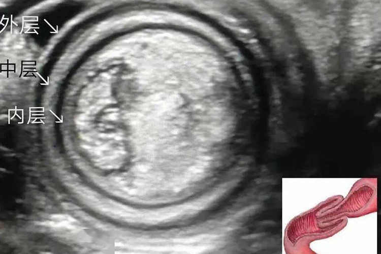 肠套叠杯口征图