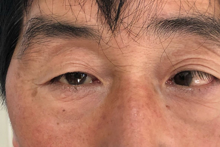 非调节性左眼轻微内斜视图 非调节性左眼轻微内斜视图