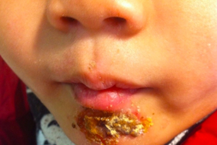 大疱型脓疱疮症状图 大疱型脓疱疮症状图