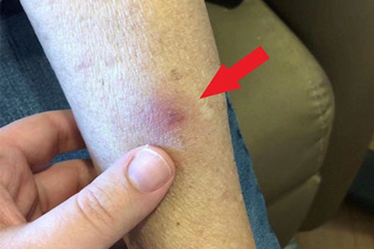 播散性镰刀菌病红斑图