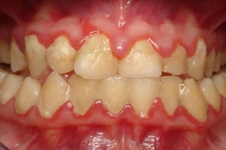 中度牙周炎牙龈脓肿图