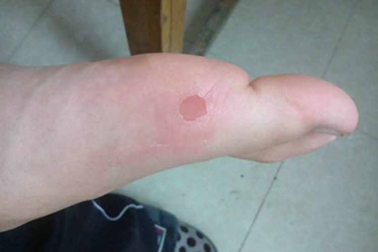 摩擦水疱糜烂图 摩擦水疱糜烂图