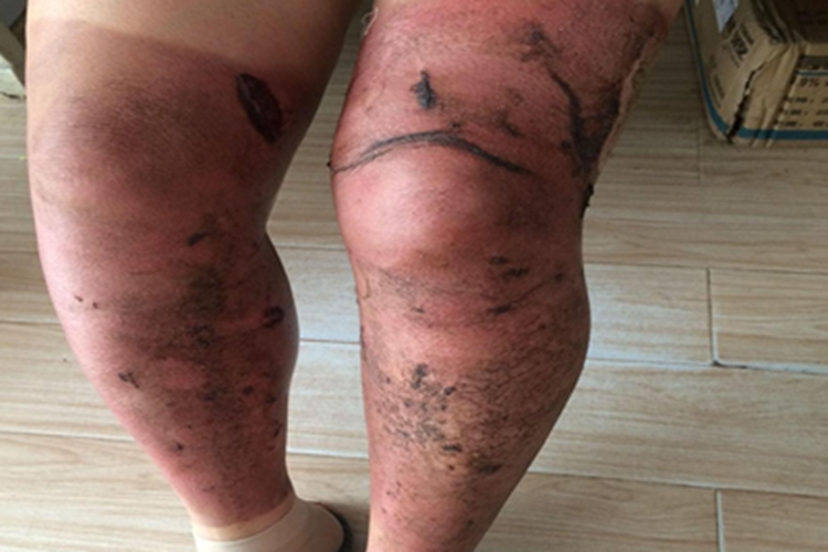 浅Ⅱ度烧伤腿脱皮图 浅Ⅱ度烧伤腿脱皮图