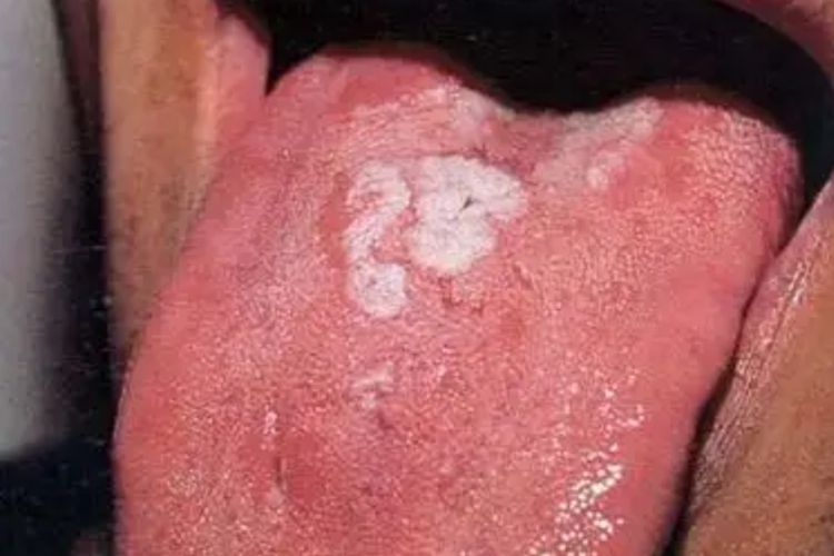 梅毒口腔症状图