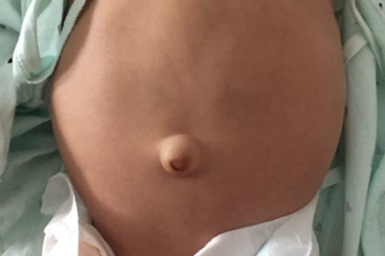 小儿脐疝肚脐凸出图