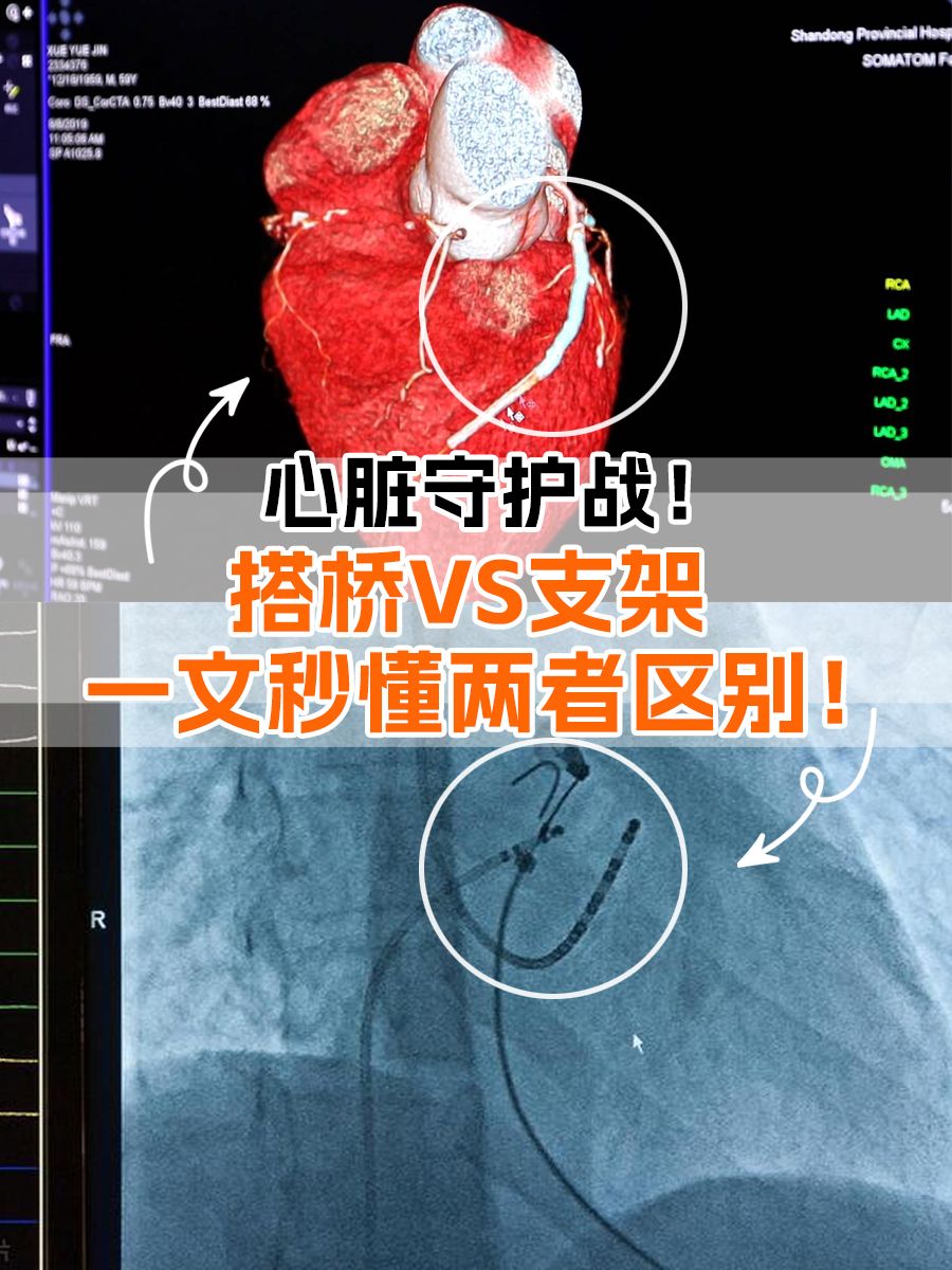 心脏守护战！搭桥VS支架一文秒懂两者区别！